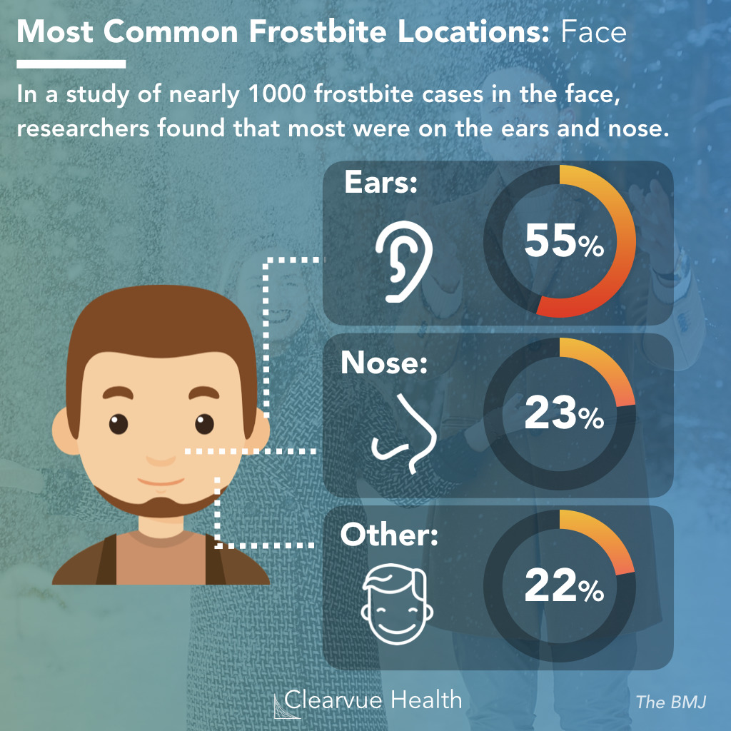Chart of Frostbite locations on the face