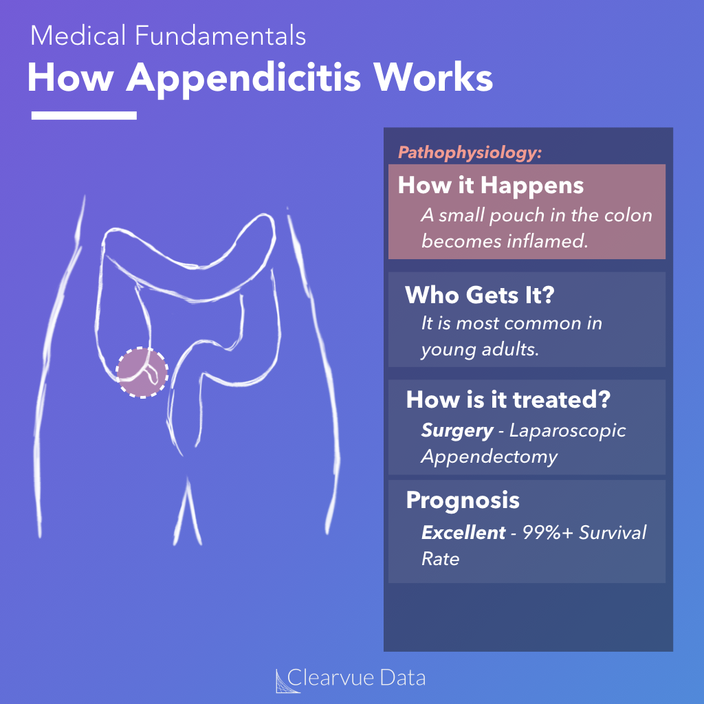 Facts about how Appendicitis works