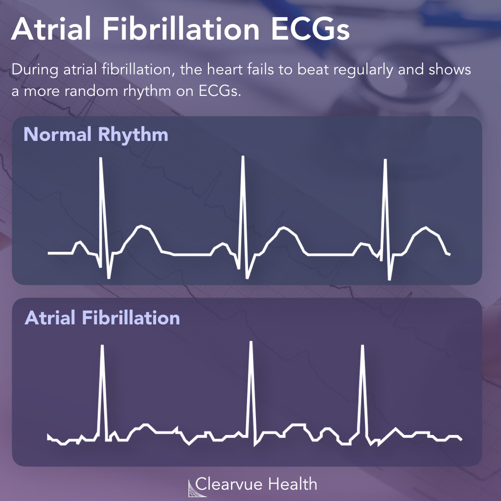 Atrial Fibrillation vs Normal Sinus Rhythm on Electrocardiogram