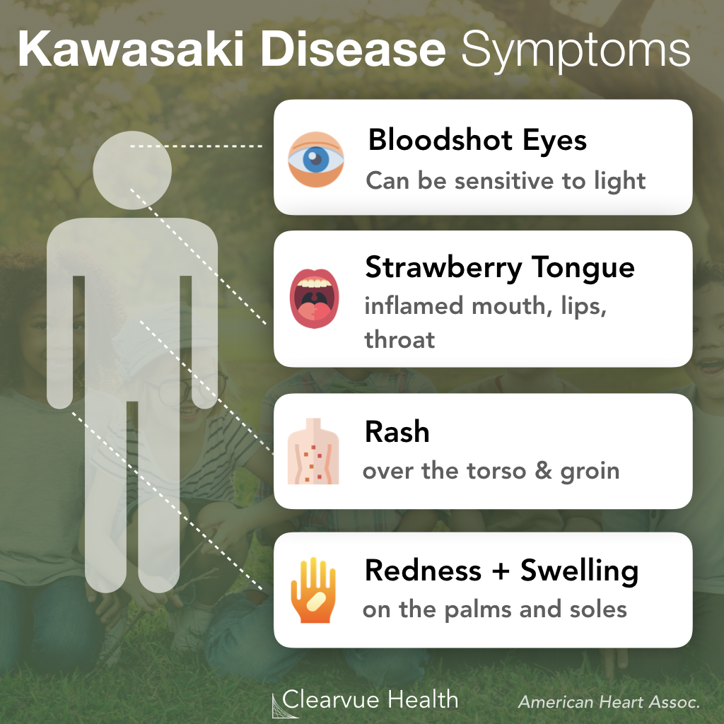 Kawasaki Disease Symptoms Chart