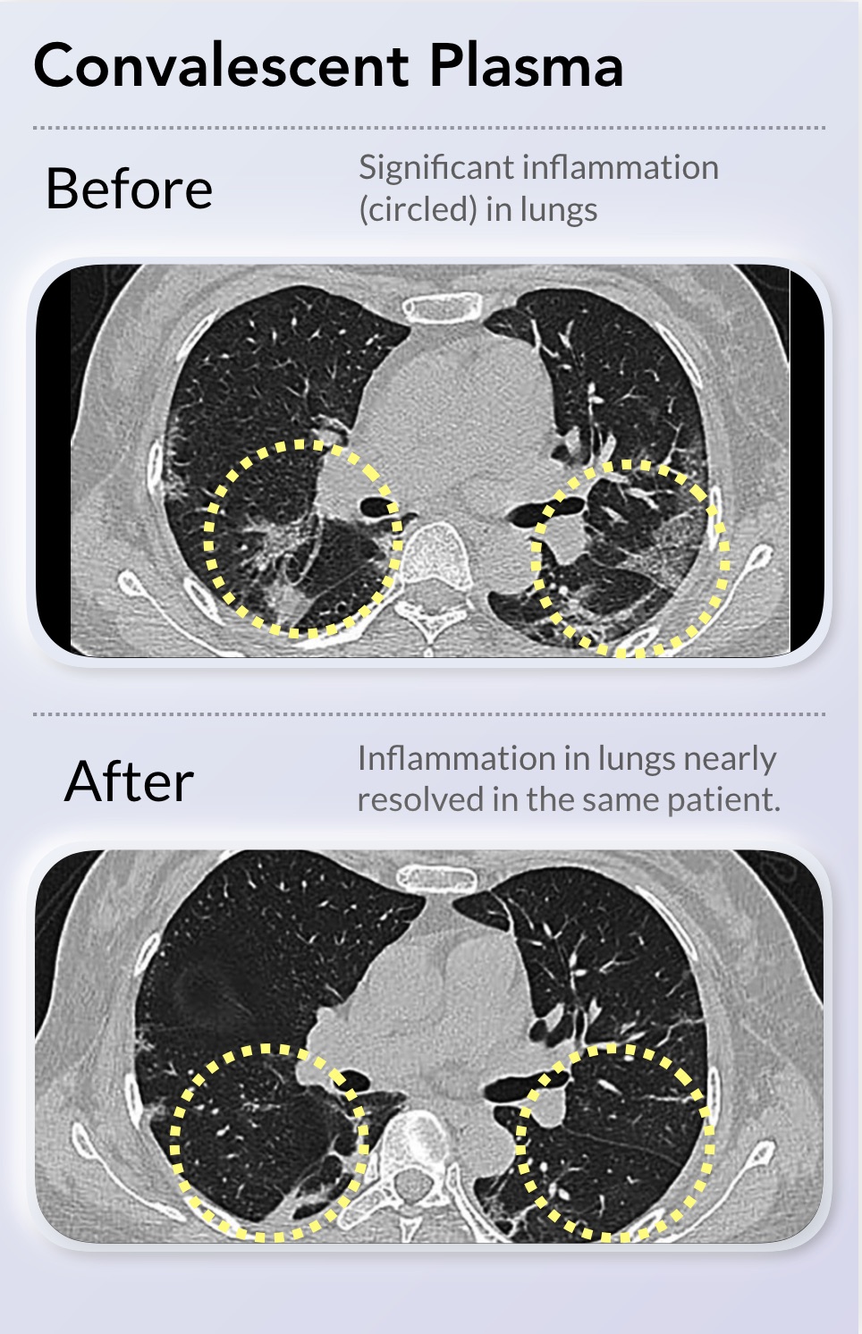 Effect of convalescent plasma on the lungs