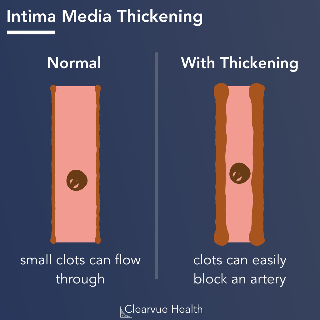 Intima Media Thickness Diagram