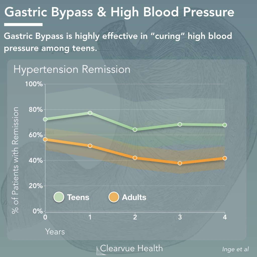 Gastric Bypass Surgery and High Blood Pressure