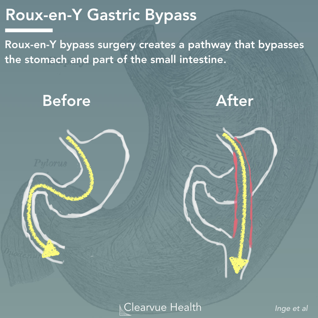 Roux-en-Y: How It's Done