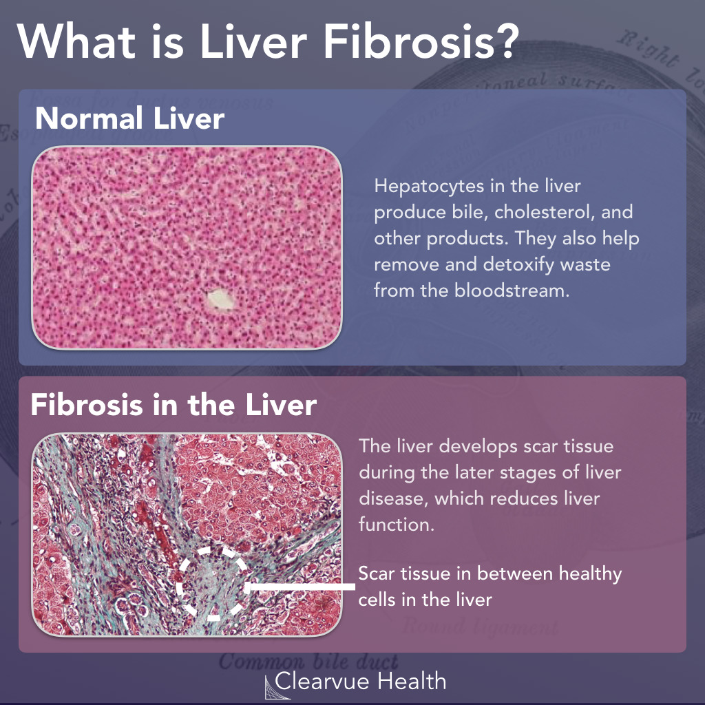  What is Liver Fibrosis.