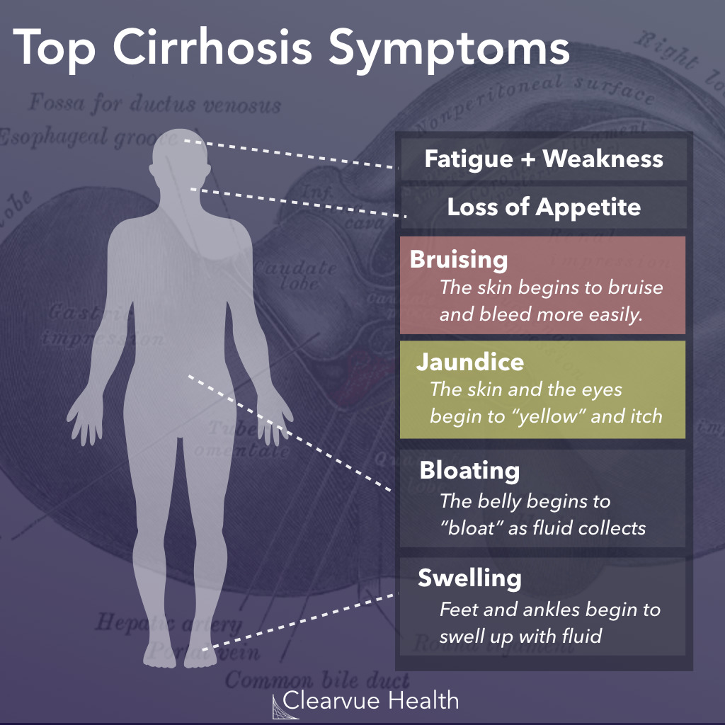 The Symptoms of Cirrhosis