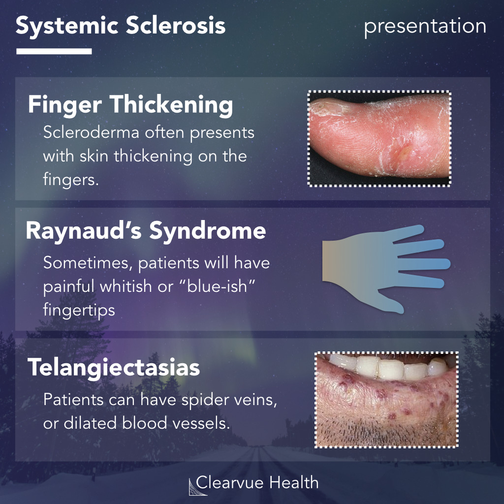 key symptoms and presentation of systemic scerlosis