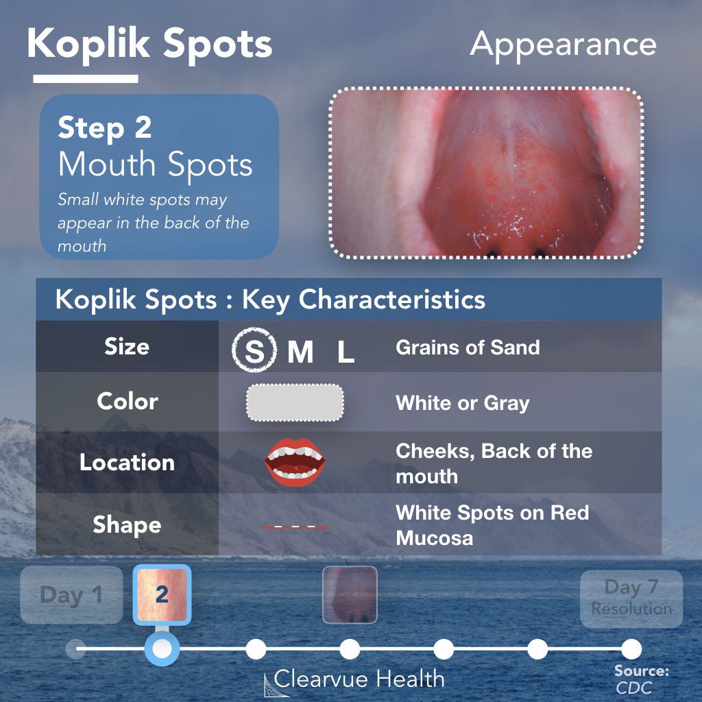 Koplik spots: key features and clinical appearance