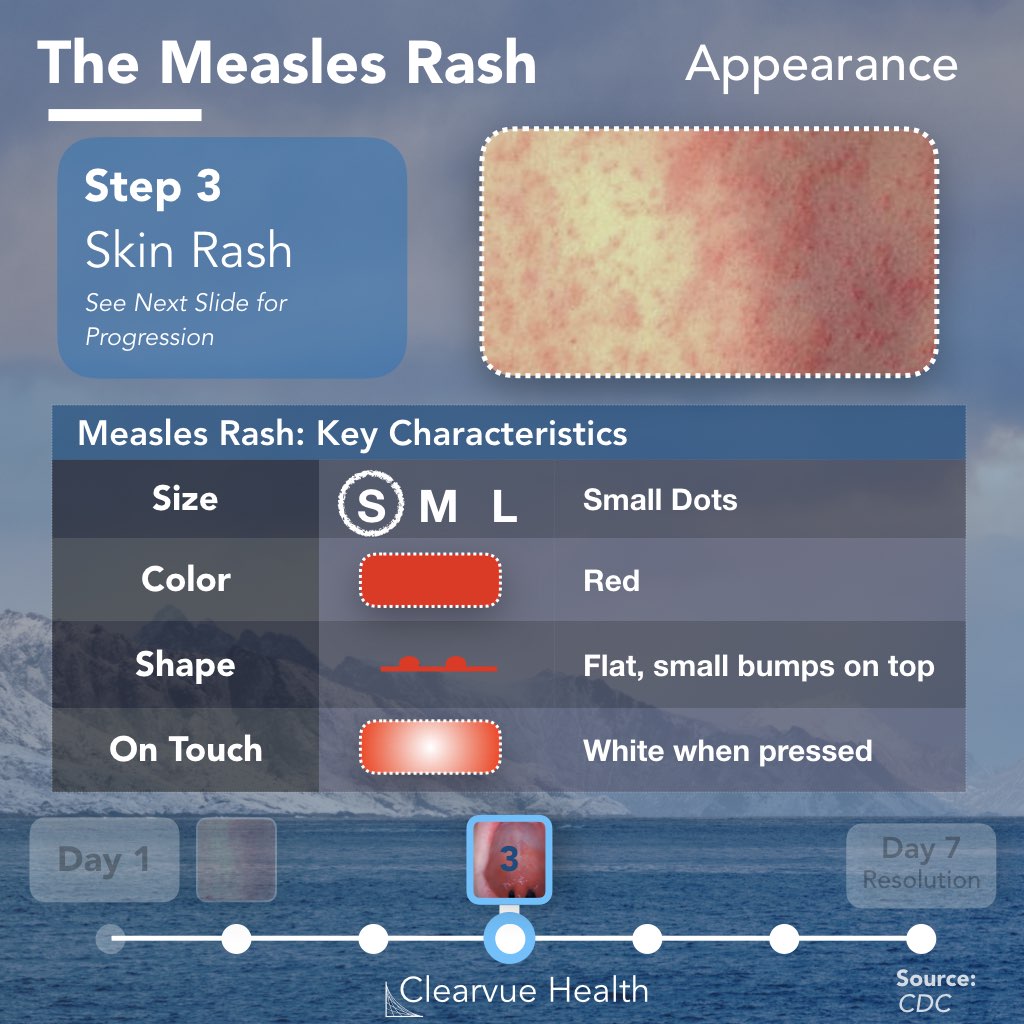 Measles Rash Appearance and Key Features
