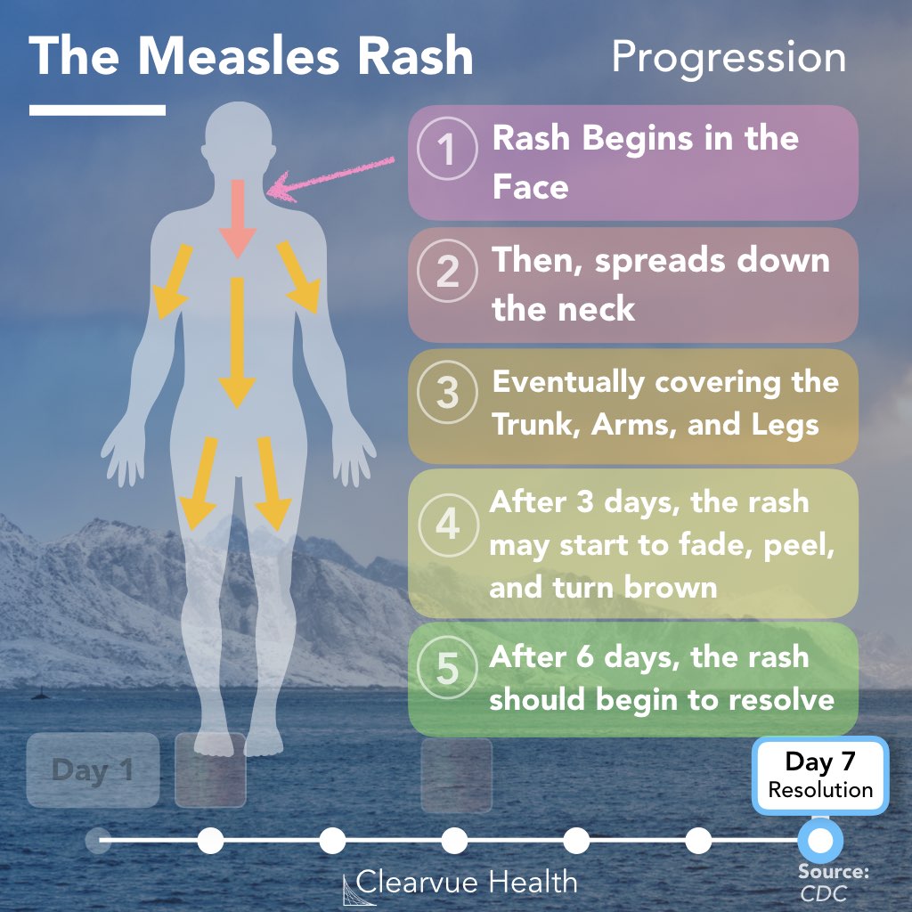 Progression of the measles rash through the neck, trunk, and extremities